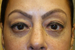 Lower Eyelid Blepharoplasty + Xeomin