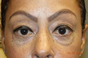 Lower Eyelid Blepharoplasty + Xeomin