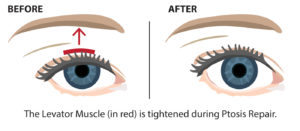 Ptosis Repair