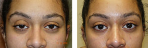 Ptosis Repair