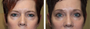 Before and After