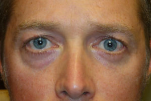 Ptosis Repair