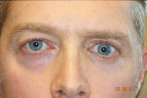Ptosis Repair