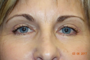 Ptosis Repair + Upper Eyelid Blepharoplasty + Internal Brow Lif