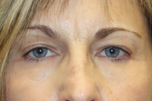 Ptosis Repair + Upper Eyelid Blepharoplasty + Internal Brow Lif