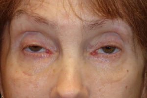 Ptosis Repair