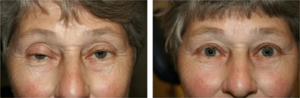 Before and After