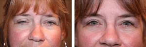 Before and After