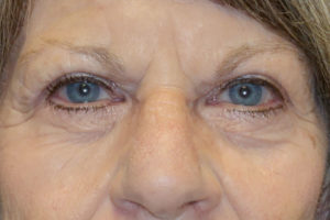 Upper Eyelid Blepharoplasty + Internal Brow Lift