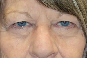 Upper Eyelid Blepharoplasty + Internal Brow Lift