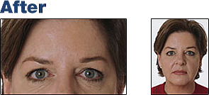 After Botox