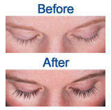 Latisse Before and After