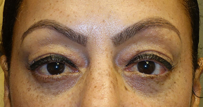 Lower Eyelid Blepharoplasty + Xeomin After
