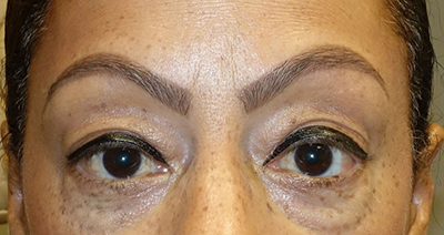 Lower Eyelid Blepharoplasty + Xeomin Before