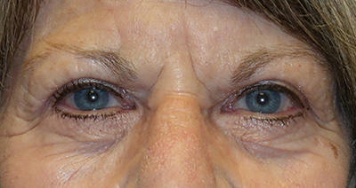 Upper Eyelid Blepharoplasty + Internal Brow Lift After