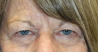 Upper Eyelid Blepharoplasty + Internal Brow Lift Before