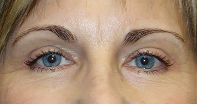 Ptosis Repair + Upper Eyelid Blepharoplasty + Internal Brow Lift After