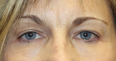 Ptosis Repair + Upper Eyelid Blepharoplasty + Internal Brow Lift Before
